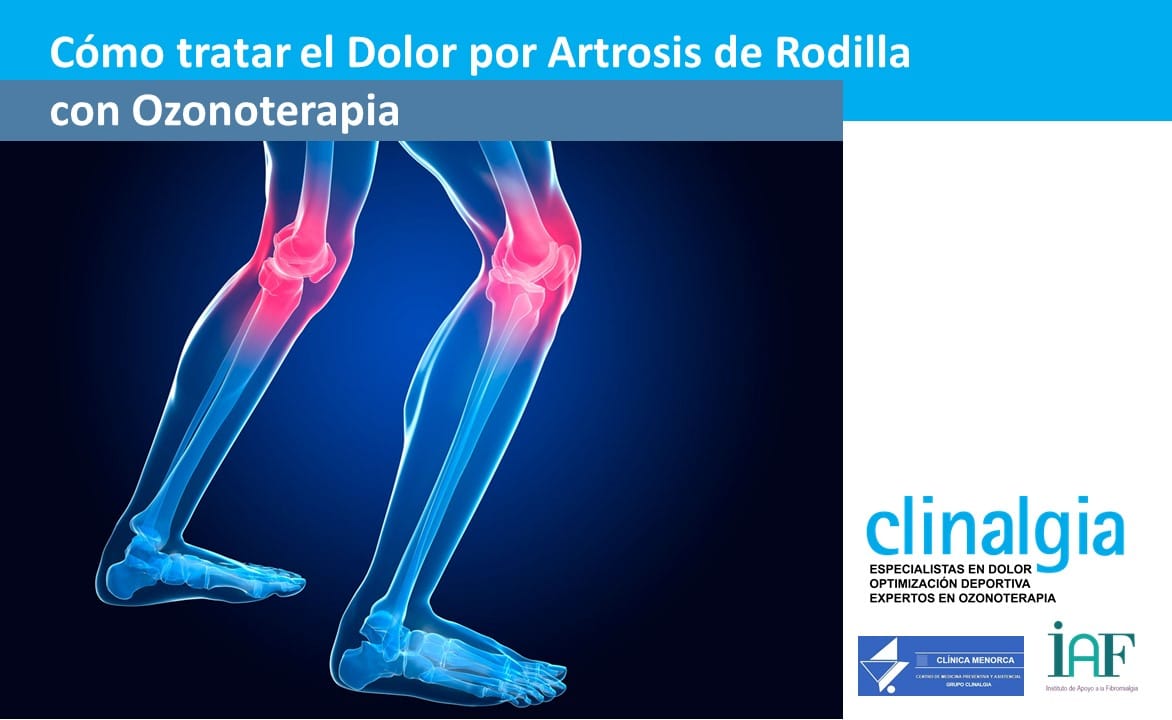 Soltero En realidad Pronunciar Cómo tratar el Dolor por Artrosis de Rodilla con Ozonoterapia | Clinalgia