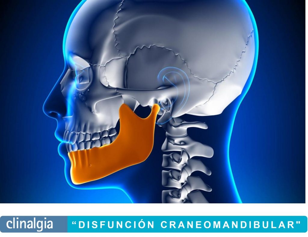 Disfunción craneomandibular