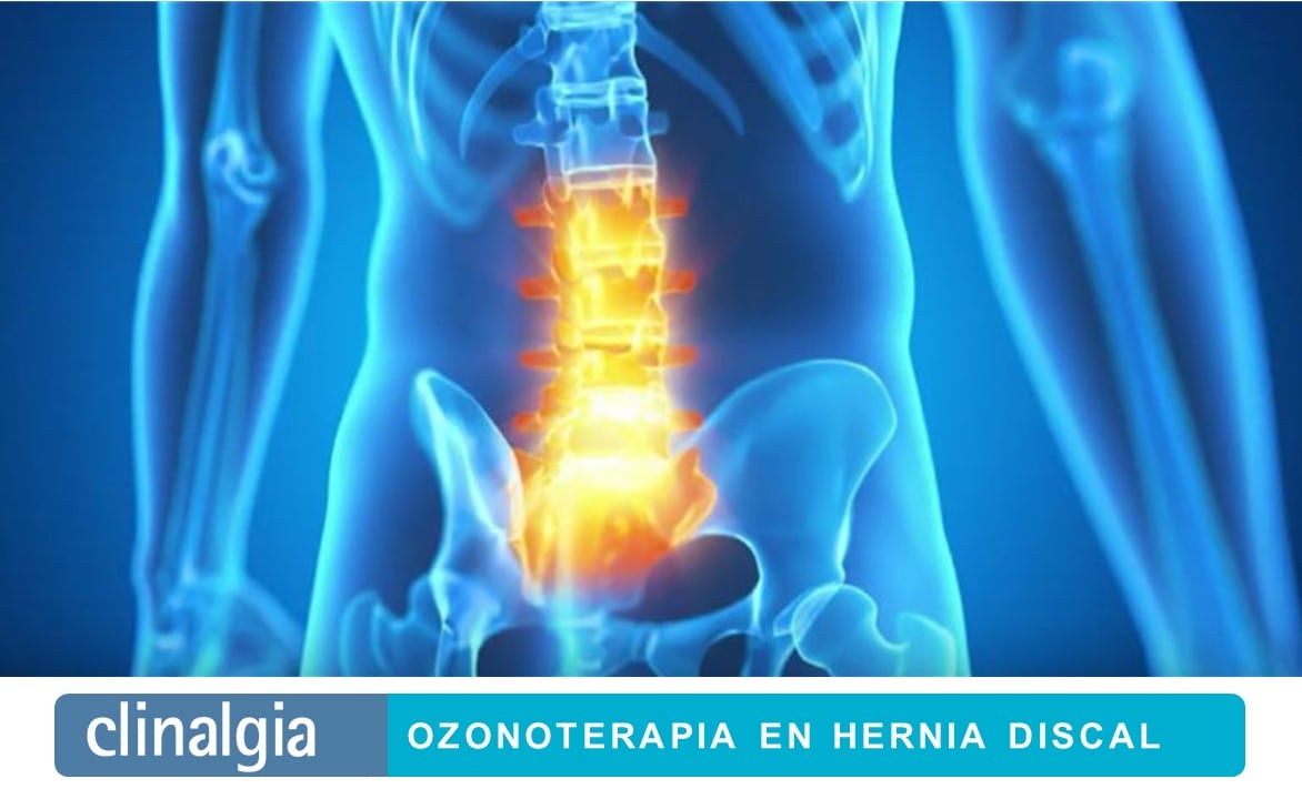 Ozonoterapia en Hernia Discal