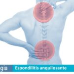 Espondilitis Anquilosante: Síntomas y Tratamiento