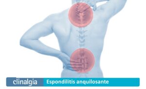 Espondilitis Anquilosante: Síntomas y Tratamiento