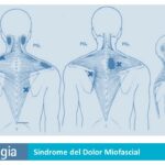 Síndrome del Dolor Miofascial: Síntomas y Tratamiento