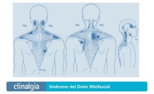Síndrome del Dolor Miofascial: Síntomas y Tratamiento