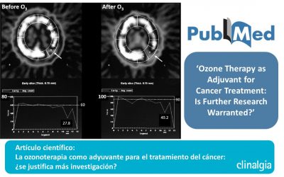 La ozonoterapia como adyuvante para el tratamiento del cáncer