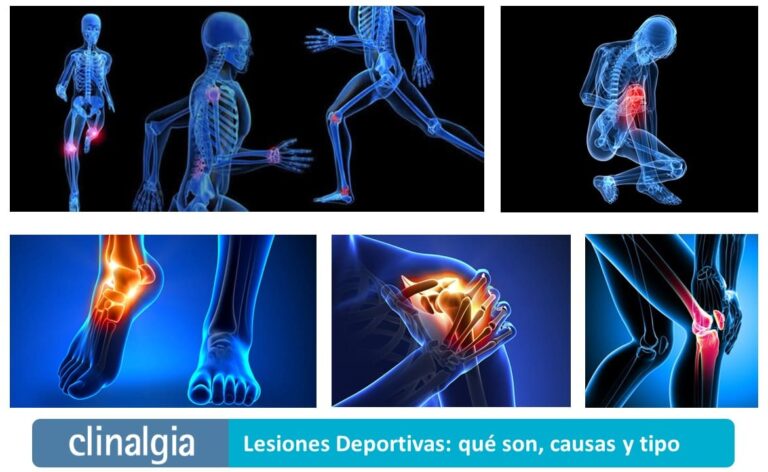 Lesiones Deportivas Qué Son Causas Y Tipo Clínica Del Deporte Clinalgia